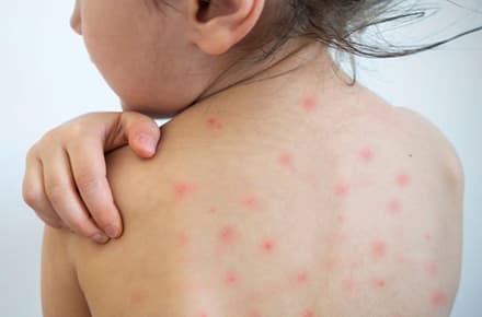 Measles Vaccination
