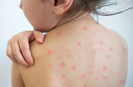 Vaccination